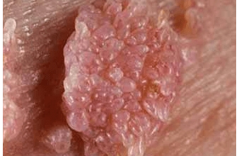 Györgytea HPV - Györgytea