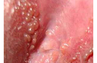 condilom vulva