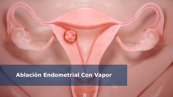 ablacion_endometrialvapor